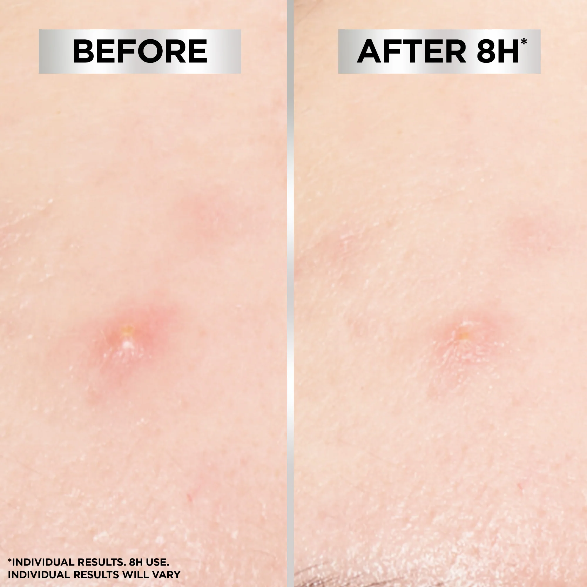 Garnier Pure Active 8 Hour Invisible Blemish Hydrocolloid Patches x44 - Image 5