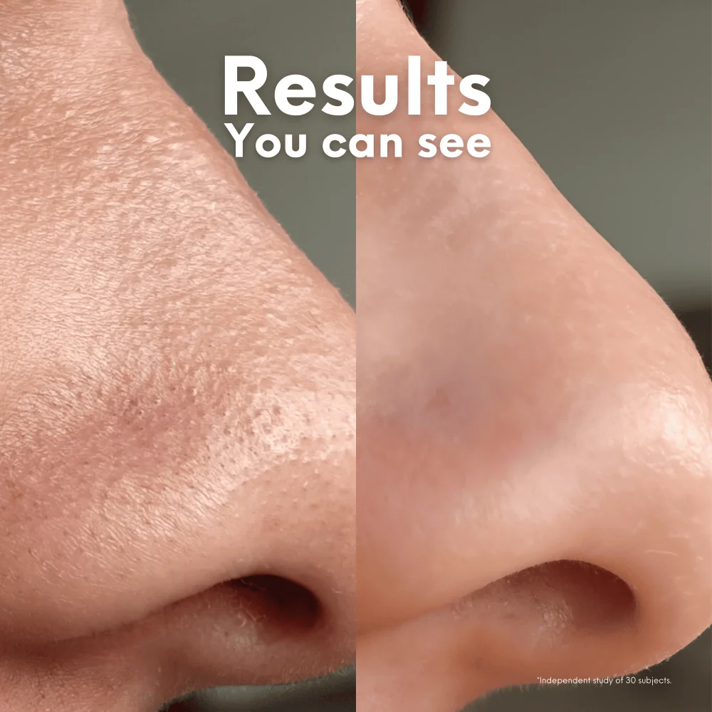 Skin Choice Breakout Patch Classic Nose x10 - Image 5