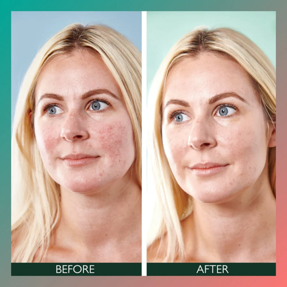 Sorted Skin 3-In-1 Anti-Redness Face Serum 30ml - Image 4